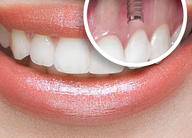 İmplant Tedavisi Kaç Günde İyileşir?