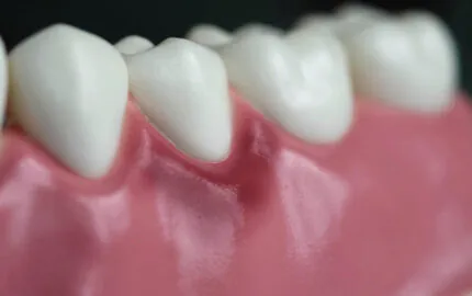 Diş Eti Çekilmesi Periodontitis