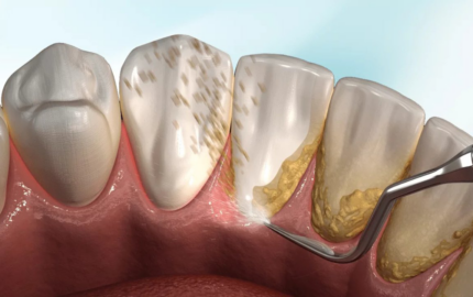 Diş Taşı Temizliği Önemi