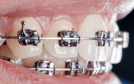 Ortodontik Tedavi Yöntemleri